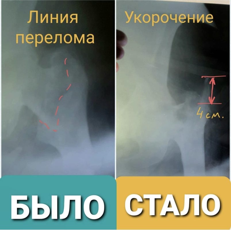 перелом шейки бедра уход дома без операции