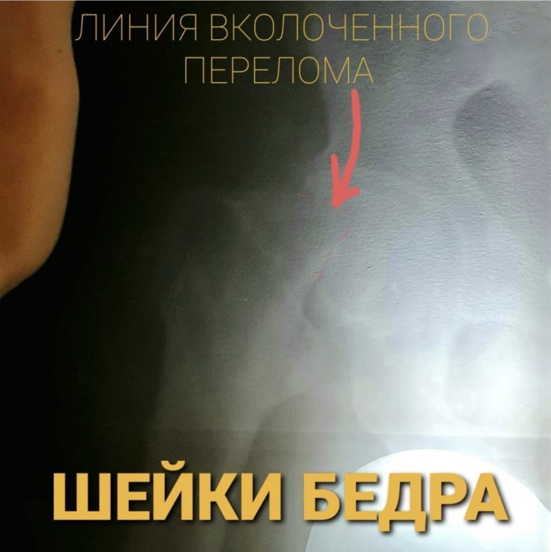 Рентгеновский снимки: перелом шейки бедра без операции