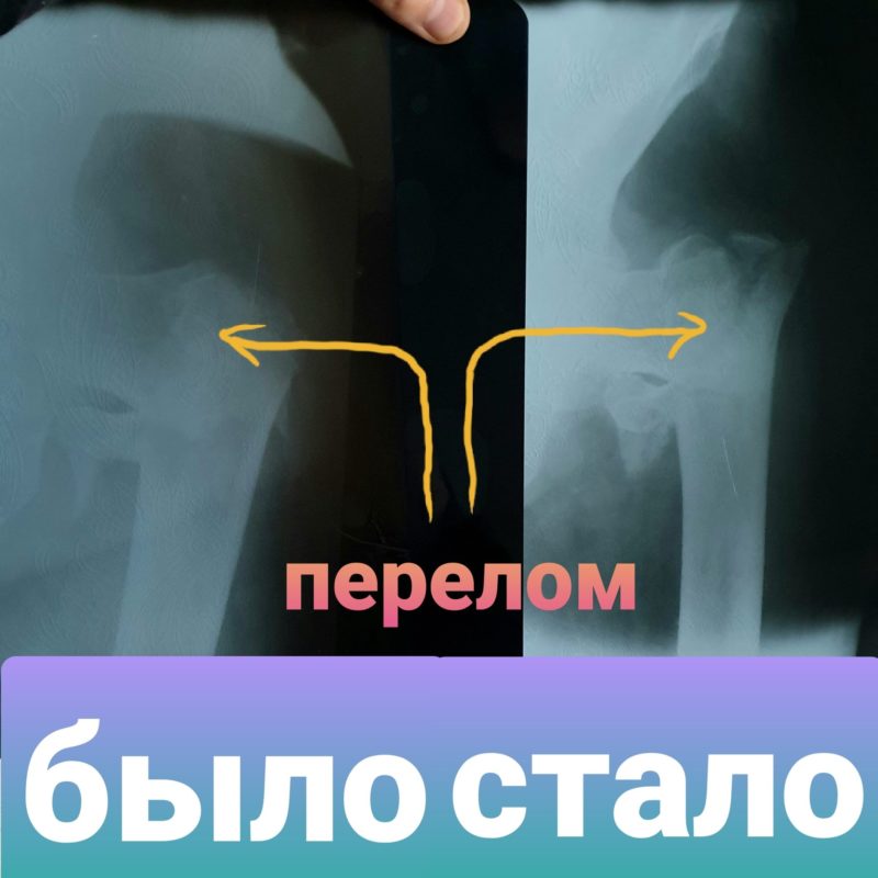 перелом шейки бедра уход дома - онлайн консультации