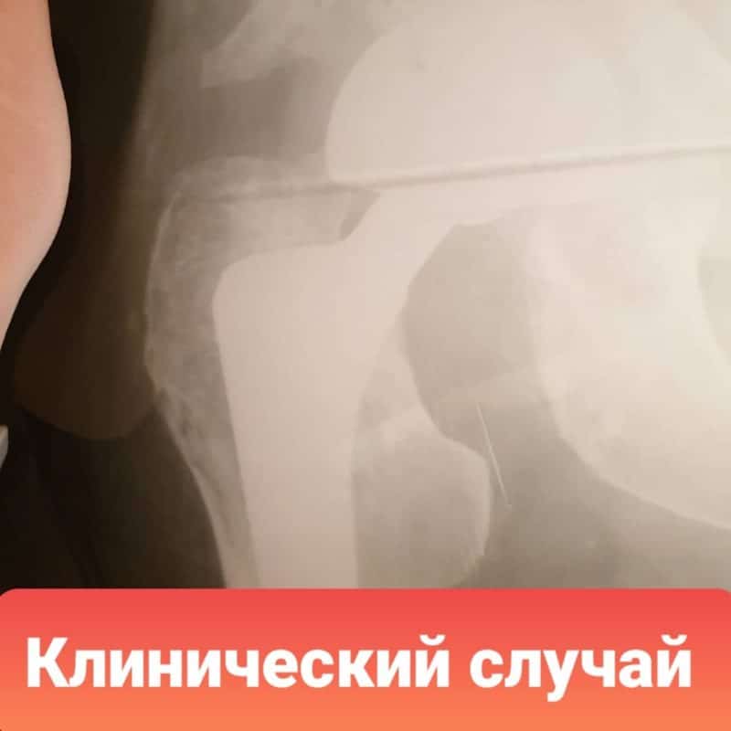 Рентгеновские снимки: перелом шейки бедра без операции