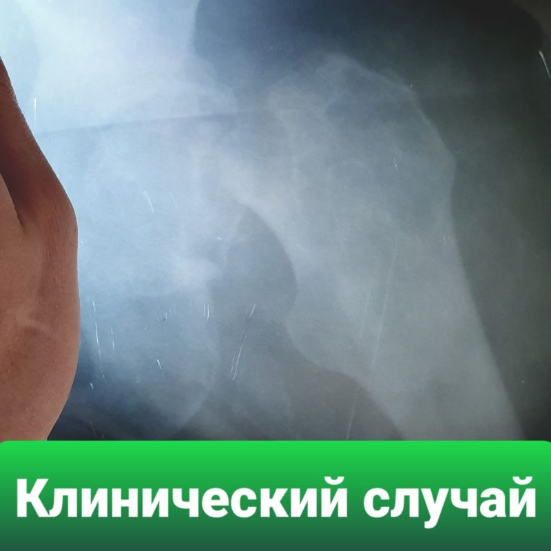 Рентгеновский снимки: перелом шейки бедра без операции