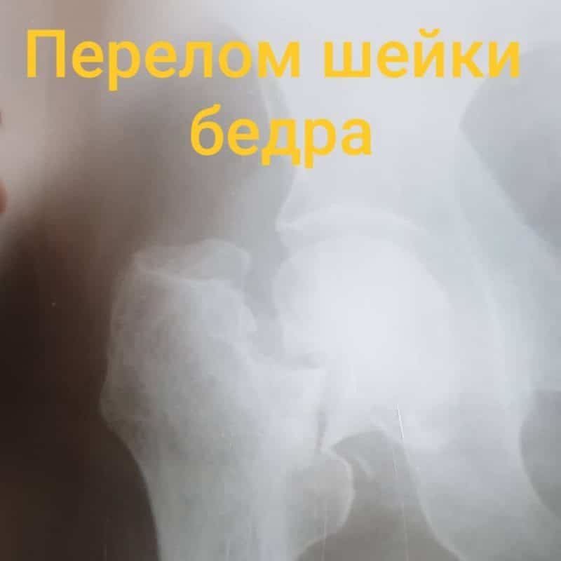 перелом шейки бедра уход дома без операции