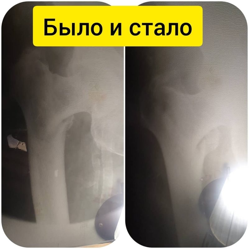 перелом шейки бедра уход дома без операции