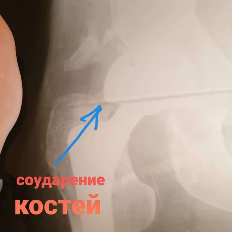 Рентгеновский снимки: перелом шейки бедра без операции